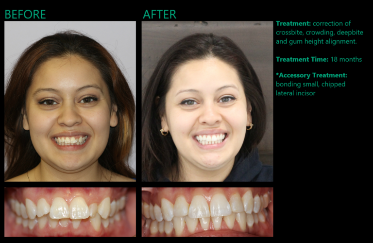 Invisalign Available at MYNT Dental Winnipeg