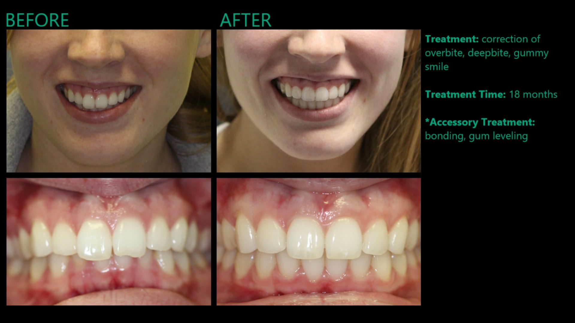 Invisalign Available at MYNT Dental Winnipeg