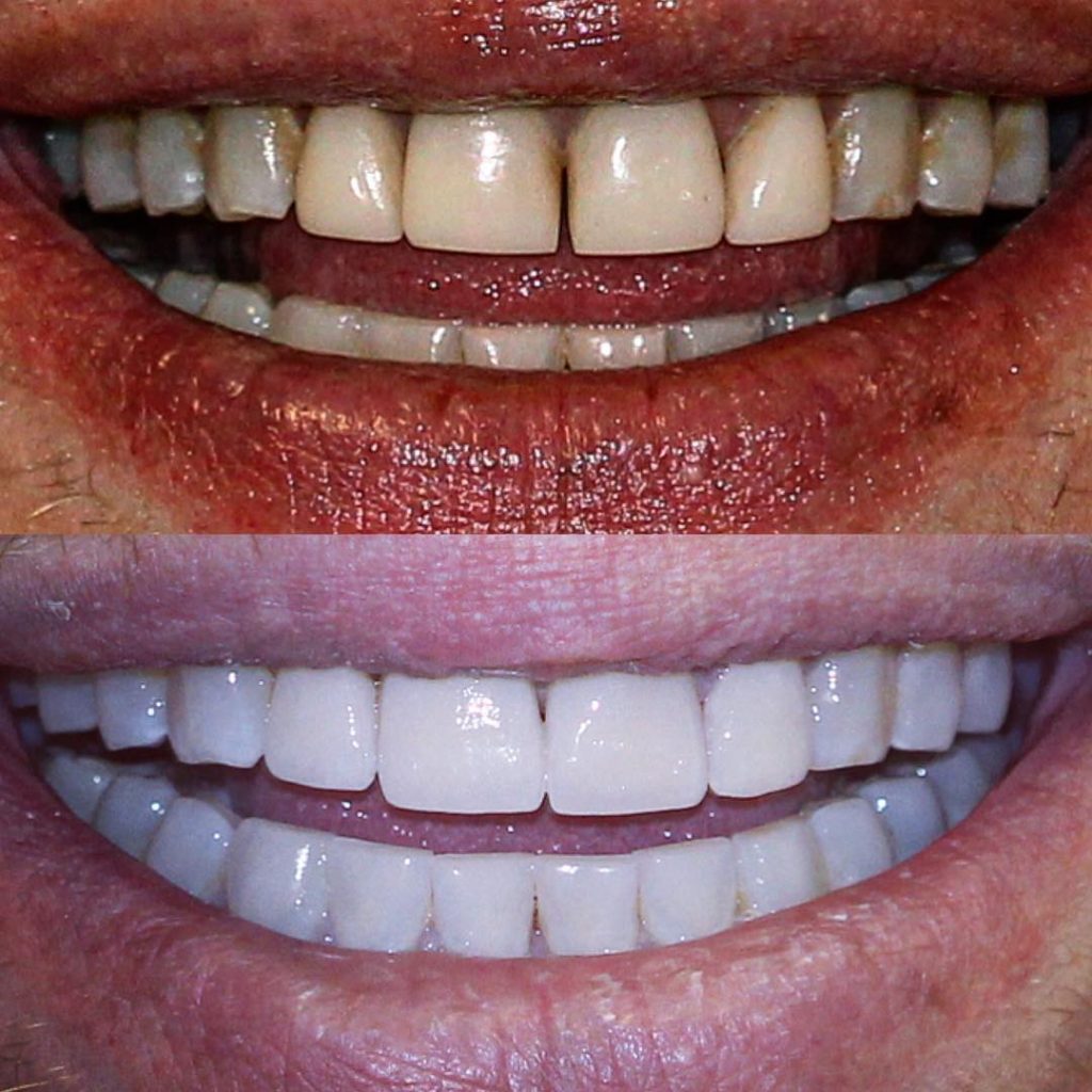 MYNT Dental Winnipeg - Teeth Whitening