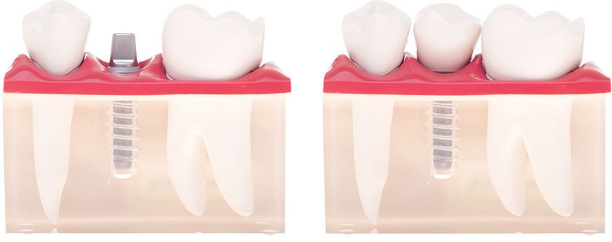 Dental Implant in Winnipeg