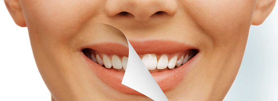 Teeth Whitening in Winnipeg
