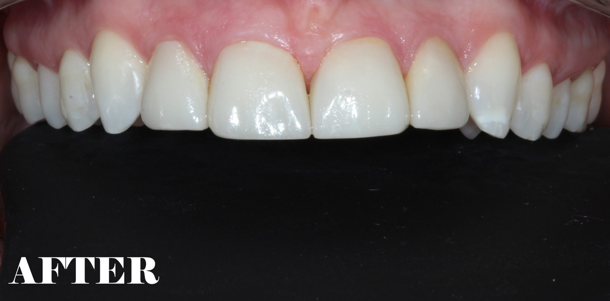 Overbite corrected - MYNT Dental Winnipeg