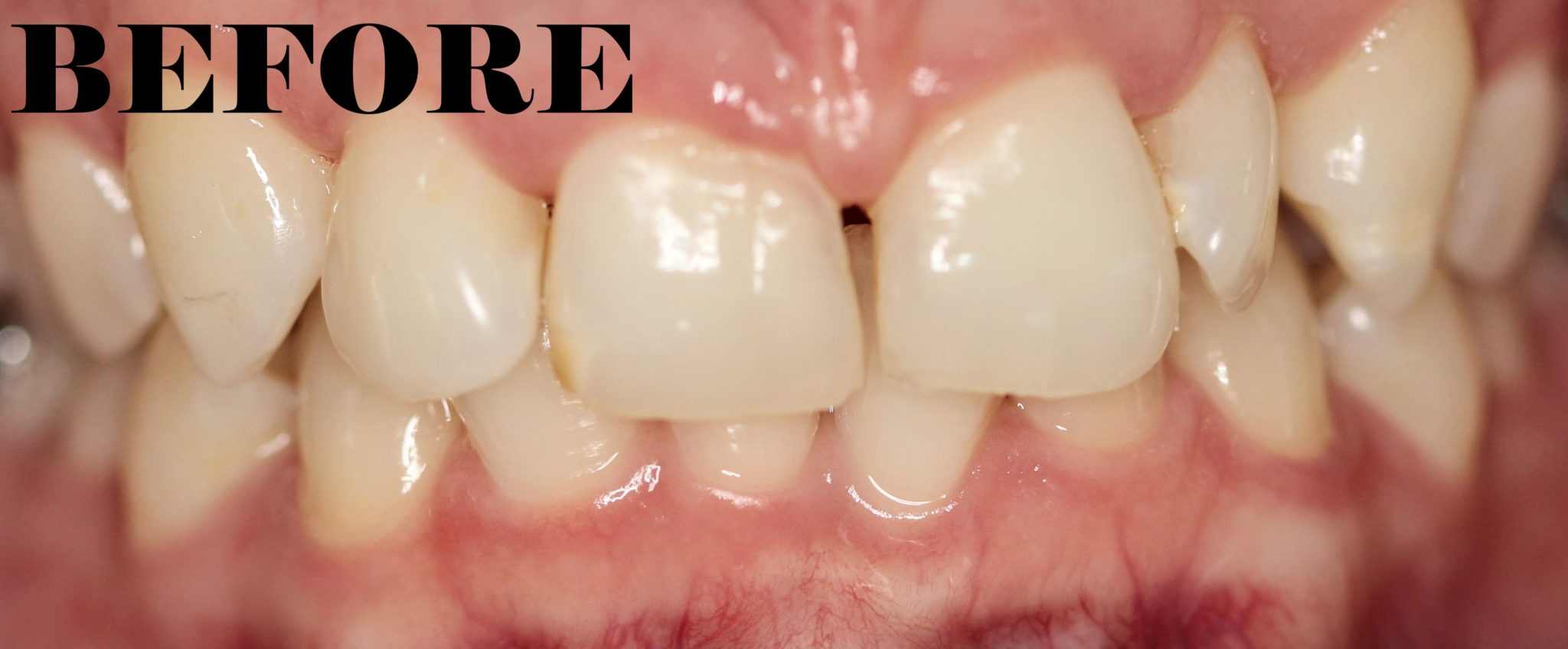 Overbite corrected MYNT Dental Winnipeg