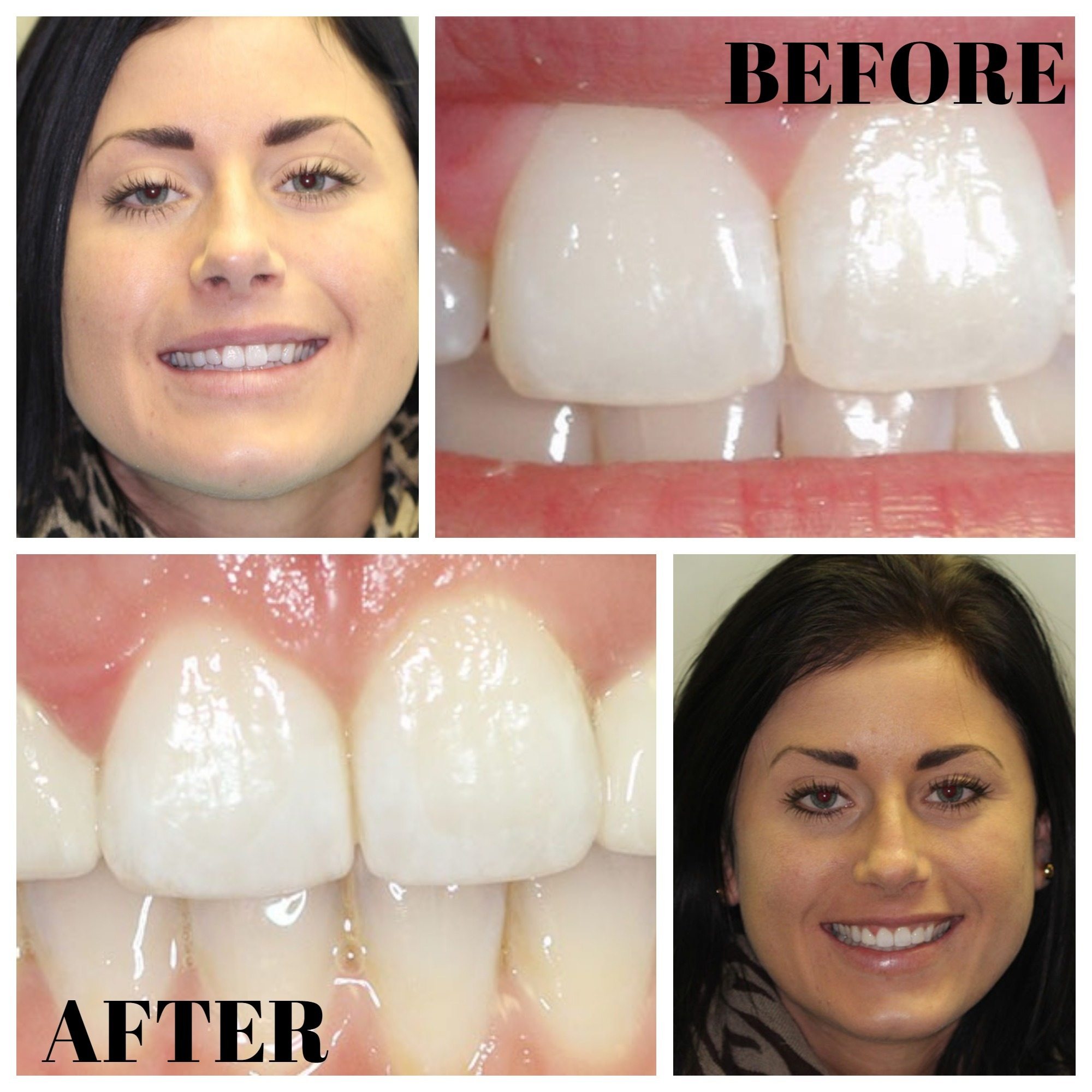 Porcelain Veneers Before and After MYNT Dental Winnipeg