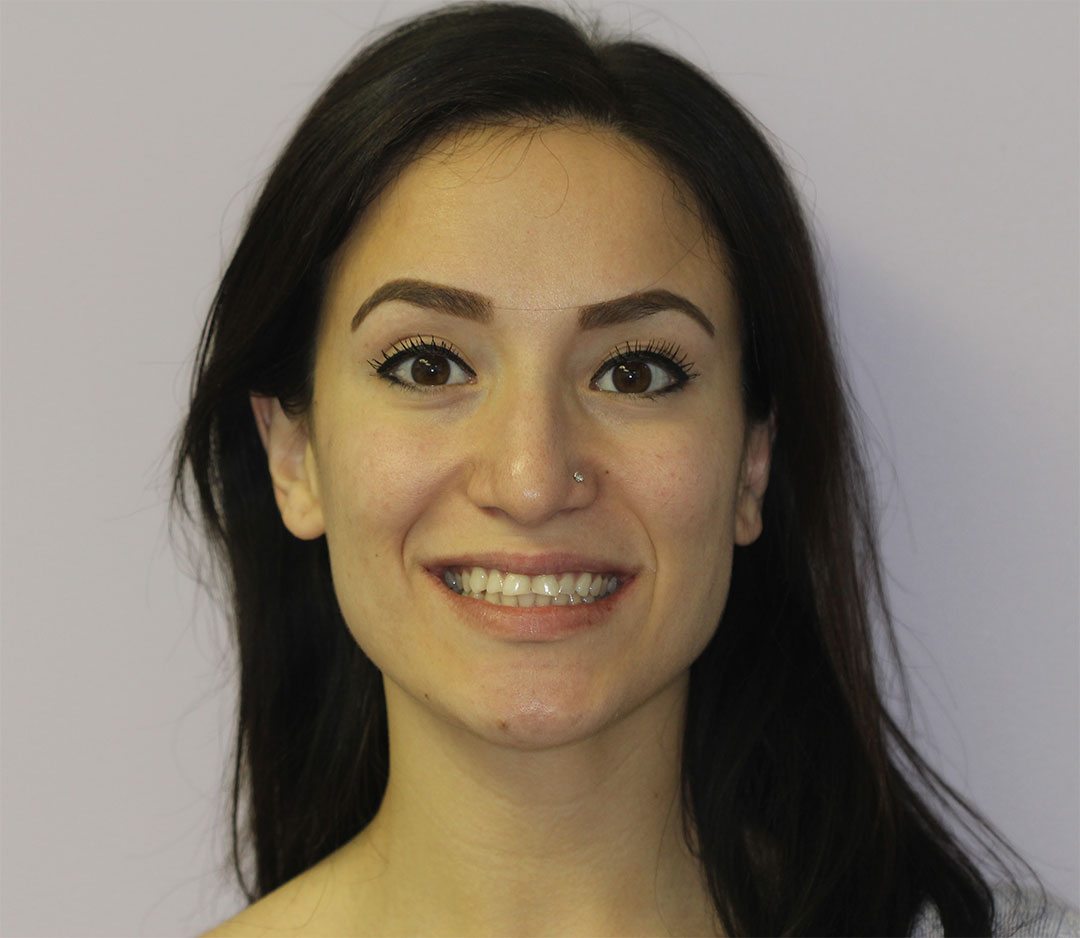 Worn Enamel Repaired MYNT Dental Winnipeg