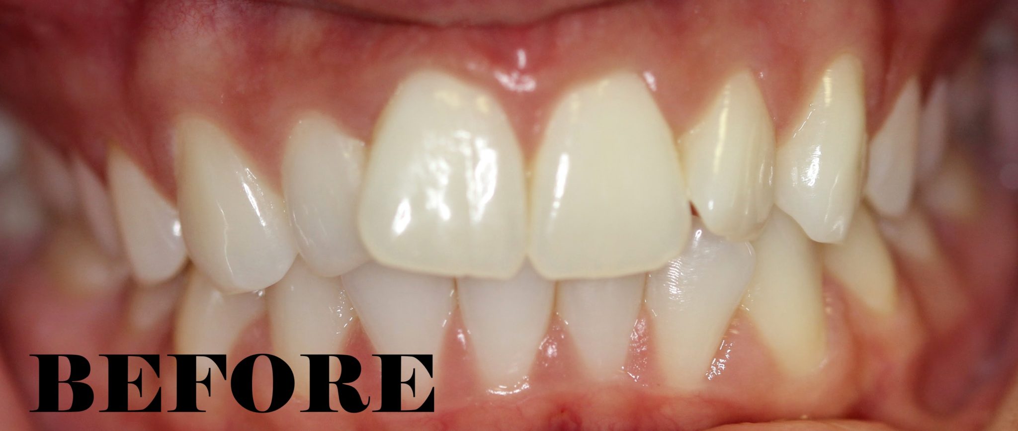 Crowded Teeth Corrected MYNT Dental Winnipeg