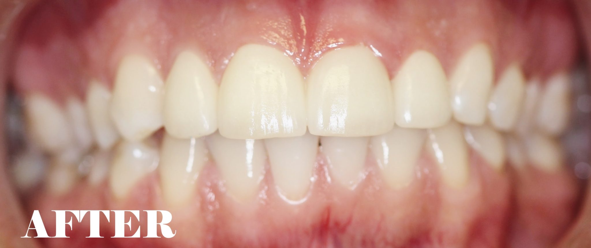 Worn Enamel Repaired MYNT Dental Winnipeg