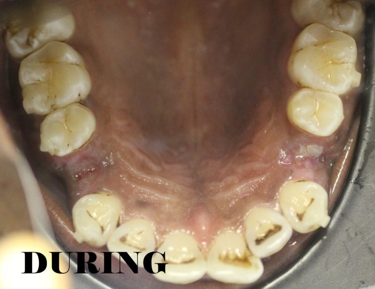 Flared Teeth Corrected MYNT Dental Winnipeg