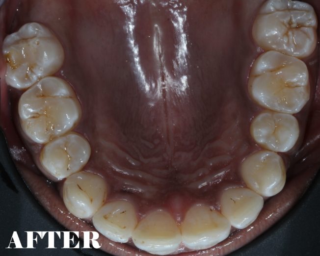 Flared Teeth Corrected MYNT Dental Winnipeg