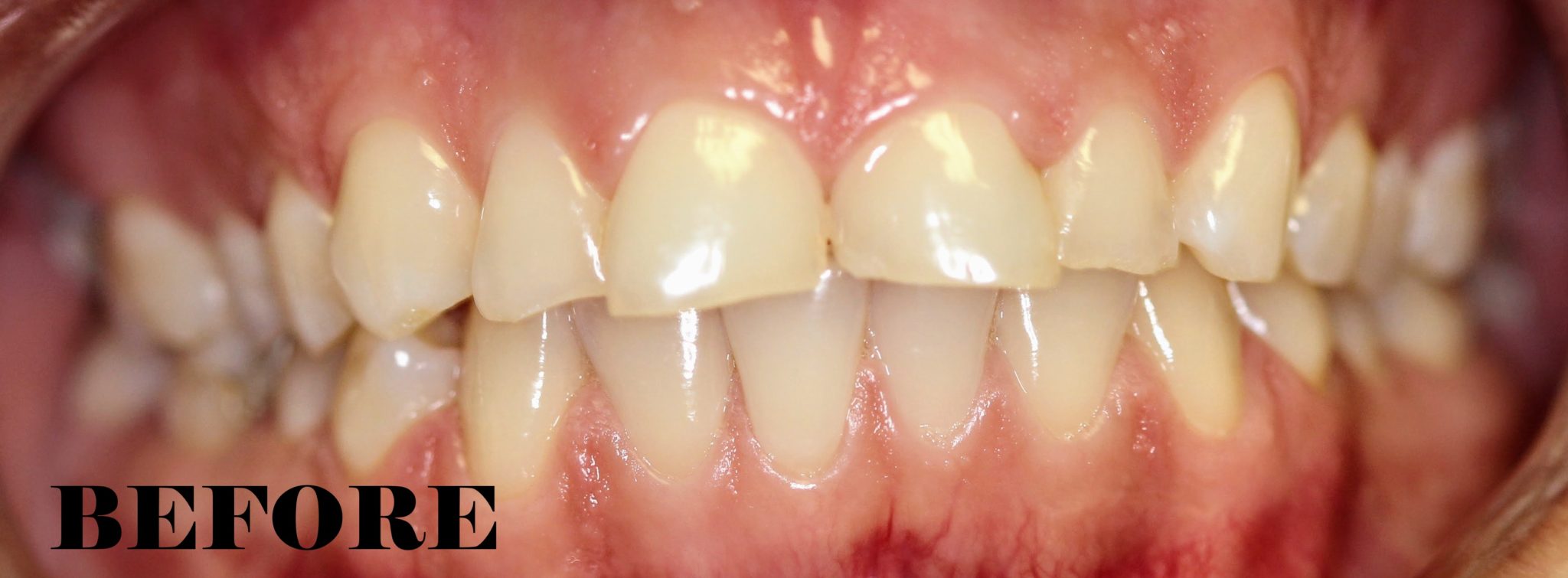 Worn Enamel Repaired MYNT Dental Winnipeg