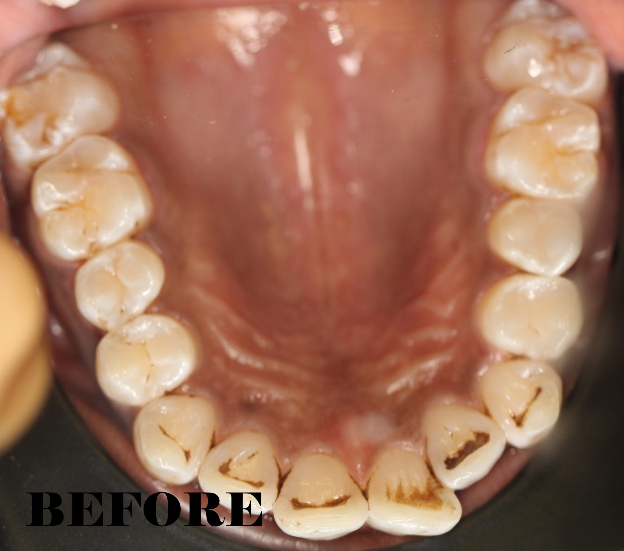 Flared Teeth Corrected - MYNT Dental Winnipeg